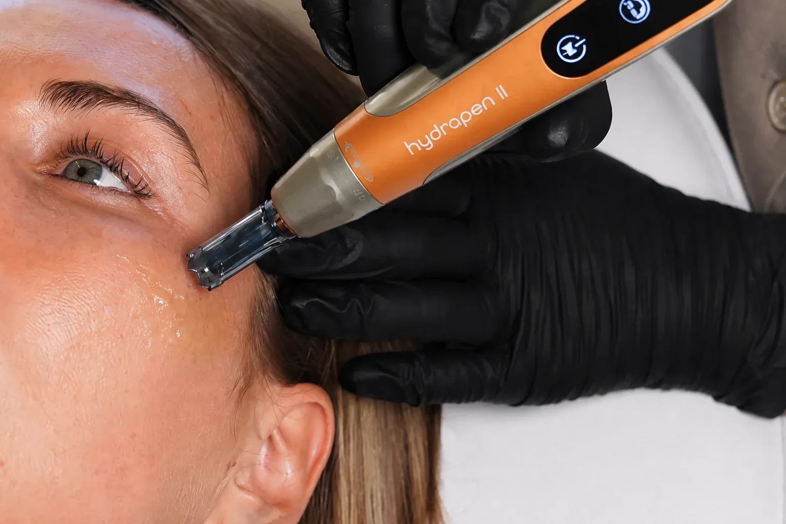 Spar 25 % på microneedling