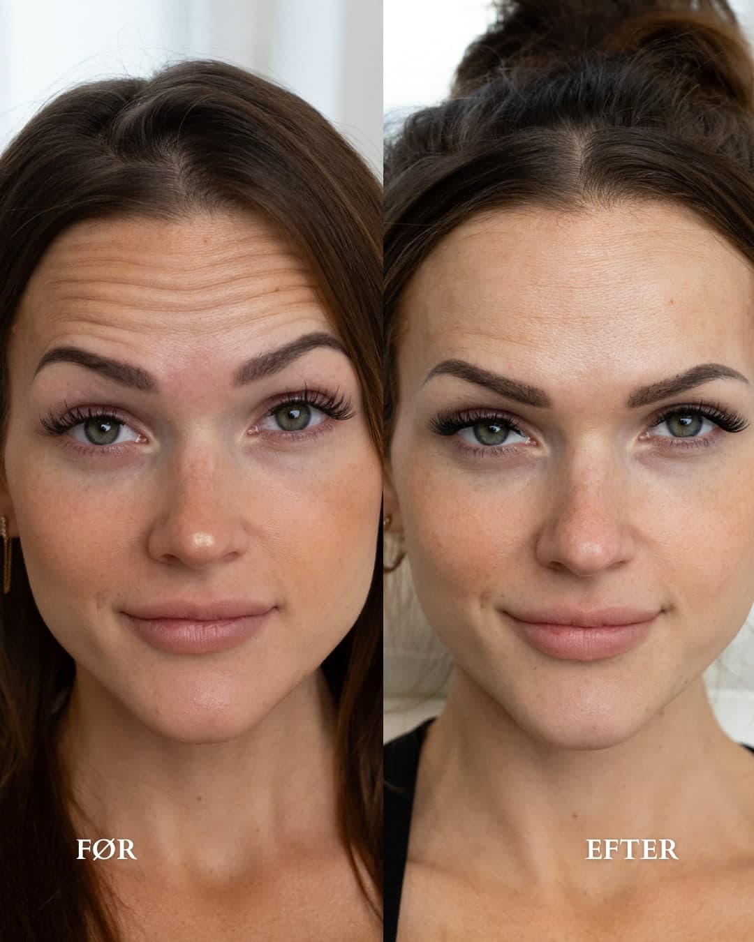 Botox i panden — før og efter hos Alma