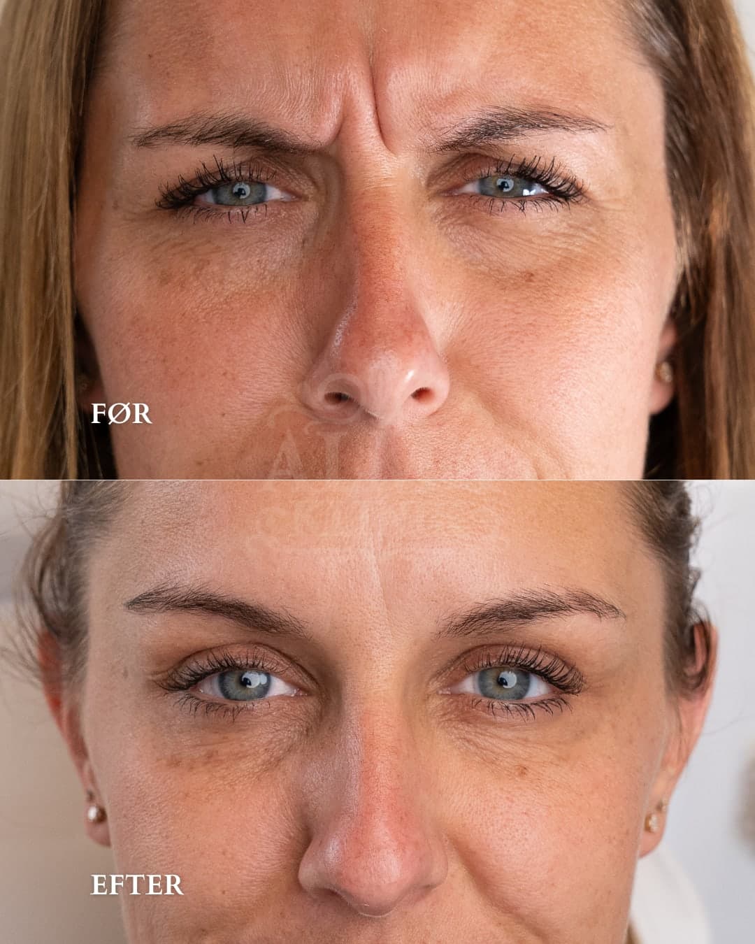 Botox i bekymringsrynken — før og efter hos Alma