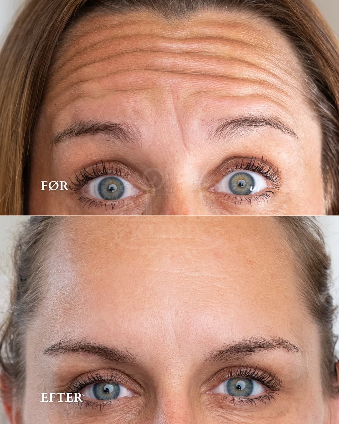 Botox i panden — før og efter hos Alma