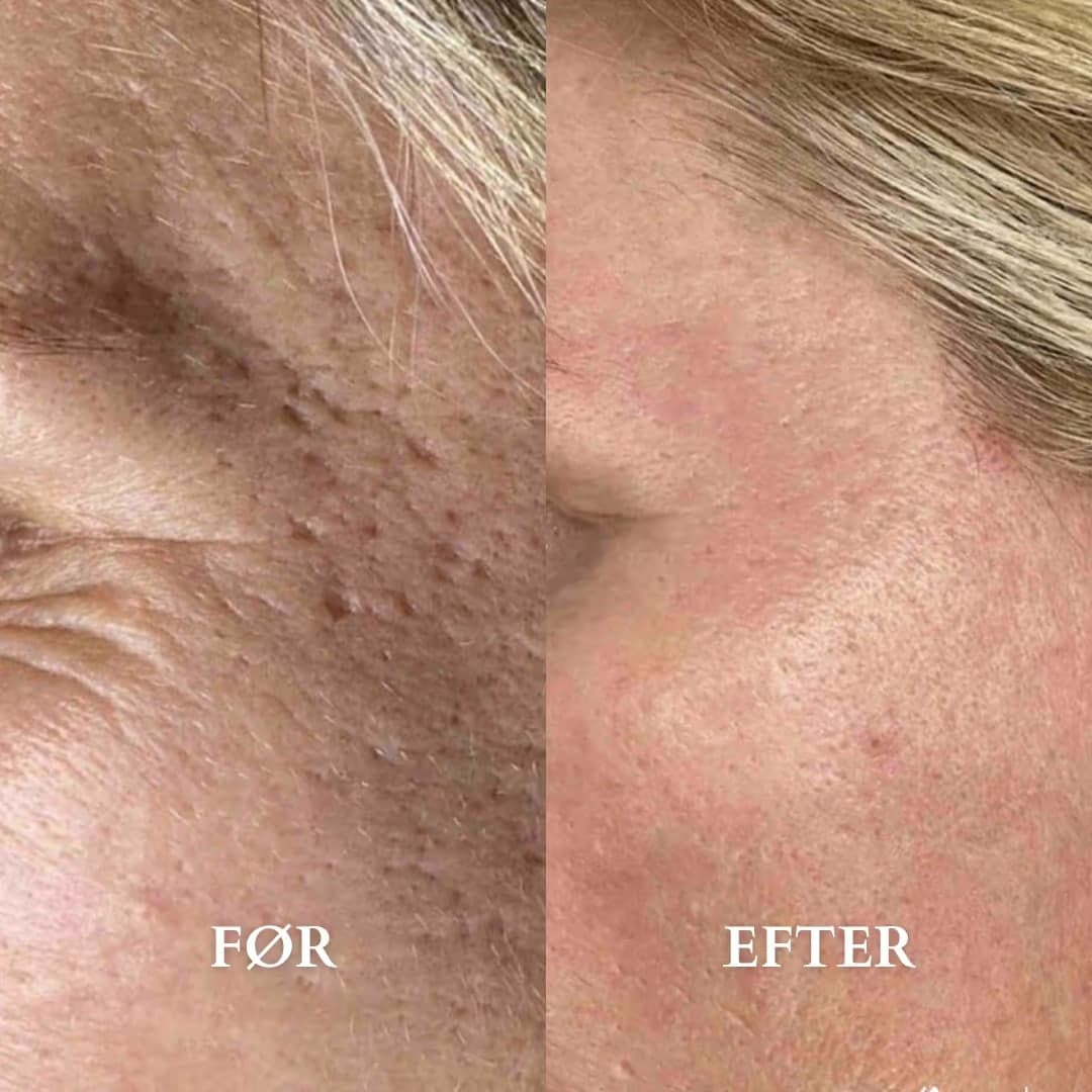 Microneedling mod aknear — før og efter hos Alma