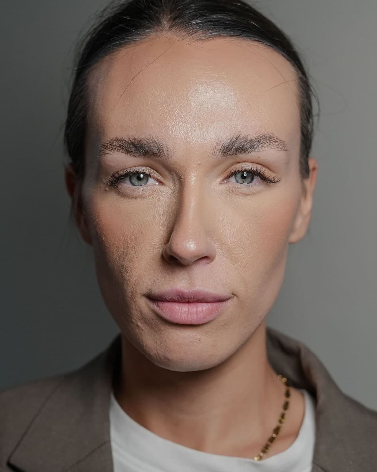 Efter: Botox — Bekymringsrynke