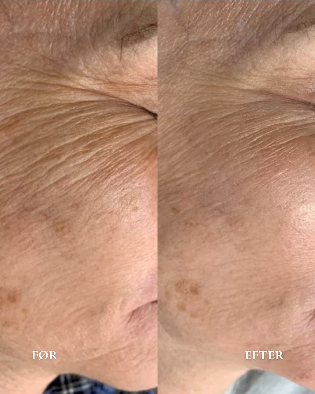 Microneedling mod fine linjer/rynker — før og efter hos Alma