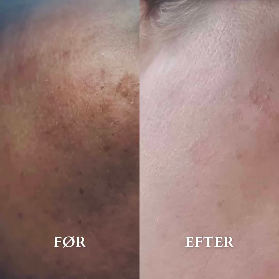 Microneedling-resultat efter én behandling med fokus på pigmentforandringer og solskader — før og efter hos Alma