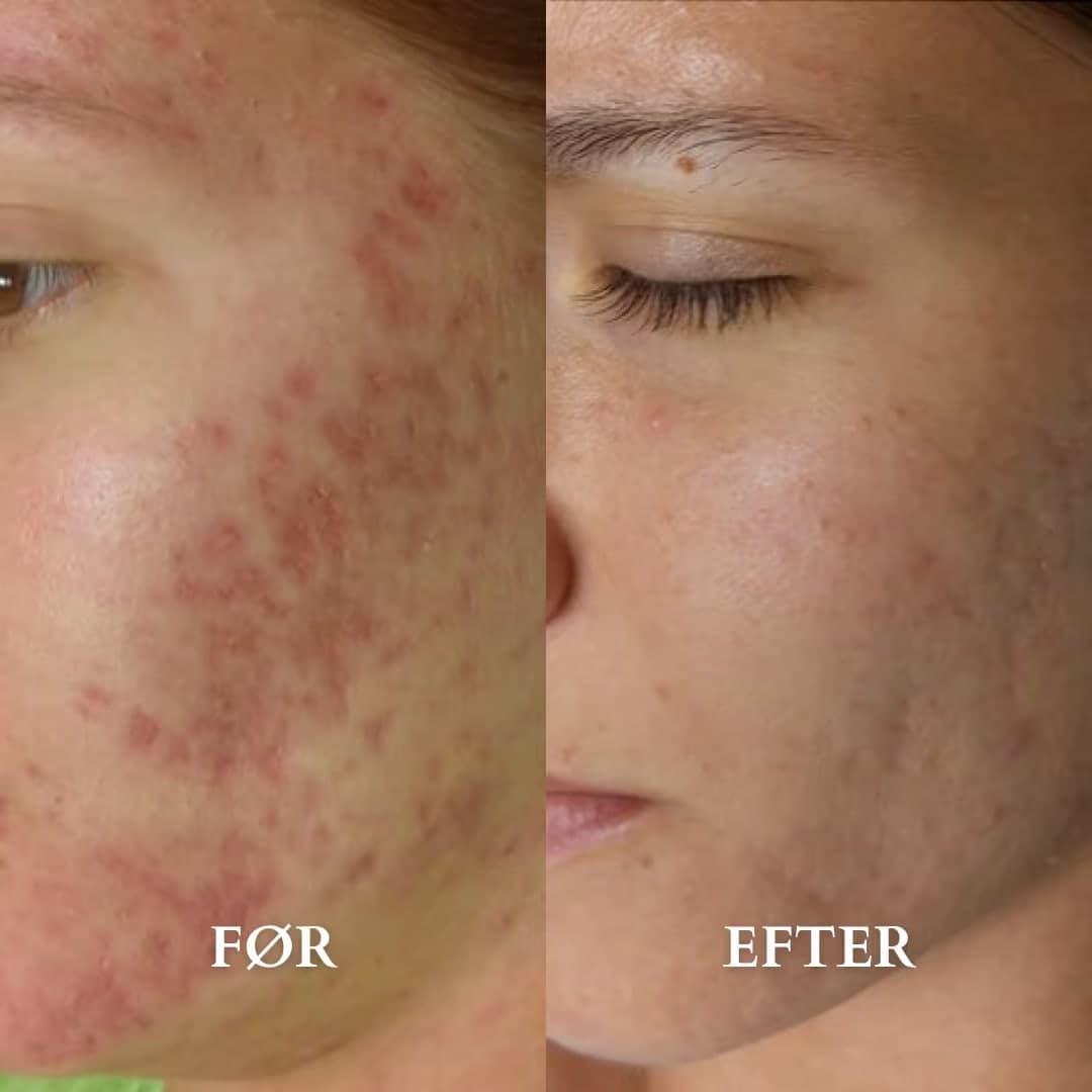 Microneedling mod akne — før og efter hos Alma